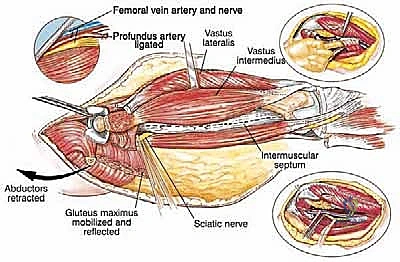 صورة توضيحية لـ استئصال عظم الفخذ وإعادة البناء بالطرف الاصطناعي: دليل شامل للمرضى مع الأستاذ الدكتور محمد هطيف في صنعاء