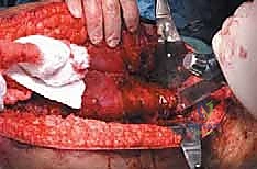 توضيح لارتباطات العضلات حول مفصل الورك والفخذ