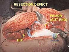 صورة طبية: استئصال عظم الفخذ وإعادة البناء بالطرف الاصطناعي: دليل شامل للمرضى مع الأستاذ الدكتور محمد هطيف في صنعاء