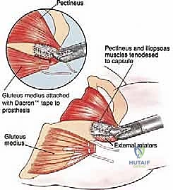 صورة طبية: استئصال عظم الفخذ وإعادة البناء بالطرف الاصطناعي: دليل شامل للمرضى مع الأستاذ الدكتور محمد هطيف في صنعاء