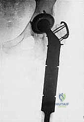 صورة توضيحية لـ استئصال عظم الفخذ وإعادة البناء بالطرف الاصطناعي: دليل شامل للمرضى مع الأستاذ الدكتور محمد هطيف في صنعاء