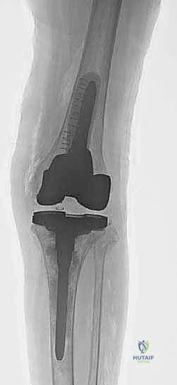 تصنيف عيوب العظام حول الركبة