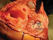 أعراض فشل مفصل الركبة الصناعي