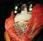 صورة توضيحية لـ مراجعة مفصل الركبة الصناعي وفقدان عظم قصبة الساق: دليل شامل للعلاج المتقدم مع الأستاذ الدكتور محمد هطيف