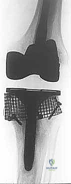 الشق الجراحي والوصول للمفصل