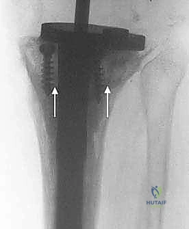 صورة توضيحية لـ مراجعة مفصل الركبة الصناعي وفقدان عظم قصبة الساق: دليل شامل للعلاج المتقدم مع الأستاذ الدكتور محمد هطيف