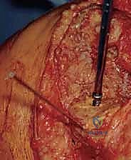 صورة توضيحية لـ مراجعة مفصل الركبة الصناعي وفقدان عظم قصبة الساق: دليل شامل للعلاج المتقدم مع الأستاذ الدكتور محمد هطيف