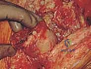Illustration of bone loss bone - Dr. Mohammed Hutaif