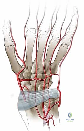 جراحة زراعة الطعم العظمي الوعائي - الخطوة الأولى