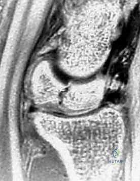 جراحة زراعة الطعم العظمي الوعائي - الخطوة الثانية