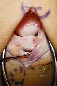 أهمية التدخل الجراحي المبكر