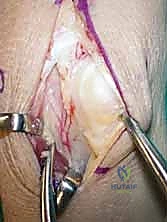 صورة توضيحية لـ مرض كينبوك وخشونة الرسغ: علاج متقدم بجراحة تطويل العظم الوعائي وتقصير العظم الكبير مع الأستاذ الدكتور محمد هطيف