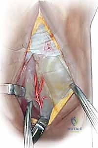 صورة توضيحية لـ مرض كينبوك وخشونة الرسغ: علاج متقدم بجراحة تطويل العظم الوعائي وتقصير العظم الكبير مع الأستاذ الدكتور محمد هطيف