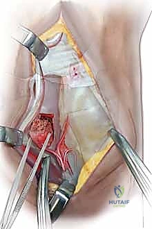 صورة توضيحية لـ مرض كينبوك وخشونة الرسغ: علاج متقدم بجراحة تطويل العظم الوعائي وتقصير العظم الكبير مع الأستاذ الدكتور محمد هطيف