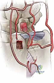 صورة توضيحية لـ مرض كينبوك وخشونة الرسغ
