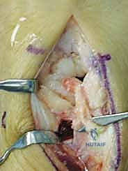 التشريح الدقيق للرسغ والعظم الهلالي