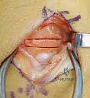 مرض كينبوك وخشونة الرسغ: علاج متقدم بجراحة تطويل العظم الوعائي وتقصير العظم الكبير مع الأستاذ الدكتور محمد هطيف