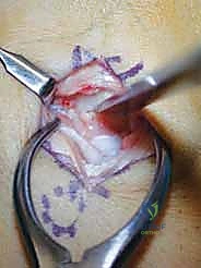 مراحل تطور مرض كينبوك