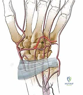 جراحة تقصير العظم الكبير - التنفيذ