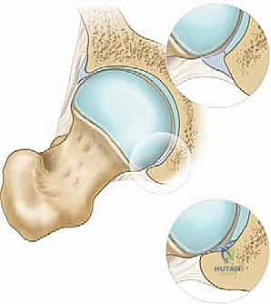عنق ورأس عظم الفخذ