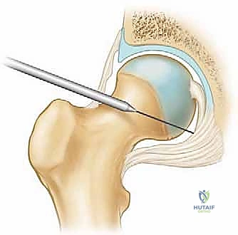 صورة توضيحية لـ تنظير مفصل الورك: دليل شامل لعلاج أمراض الأنسجة الرخوة والاصطدام الفخذي الحقي