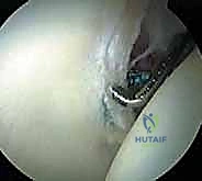 صورة طبية: تنظير مفصل الورك: دليل شامل لعلاج أمراض الأنسجة الرخوة والاصطدام الفخذي الحقي