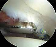 صورة توضيحية لـ تنظير مفصل الورك: دليل شامل لعلاج أمراض الأنسجة الرخوة والاصطدام الفخذي الحقي