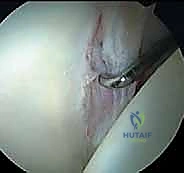 تمزق الشفا الحقي