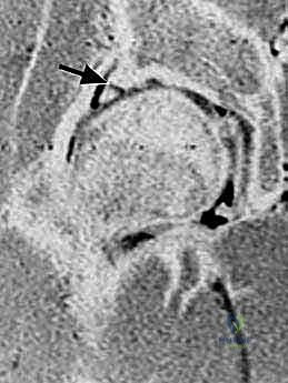 التصوير الشعاعي للورك