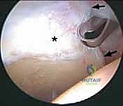 المداخل الجراحية بالمنظار