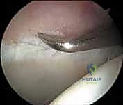 رؤية المنظار لداخل المفصل