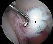 صورة طبية: تنظير مفصل الورك: دليل شامل لعلاج أمراض الأنسجة الرخوة والاصطدام الفخذي الحقي