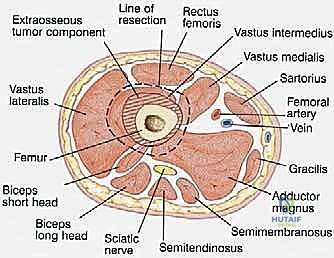 Distal Femoral Endoprosthetic Reconstruction: A Masterclass in Oncologic Limb Salvage