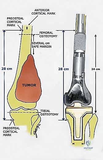 أعراض أورام العظام