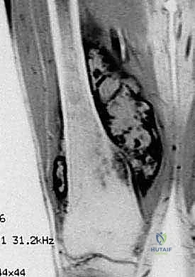 قياس عمق القناة