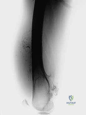 توسيع القناة العظمية