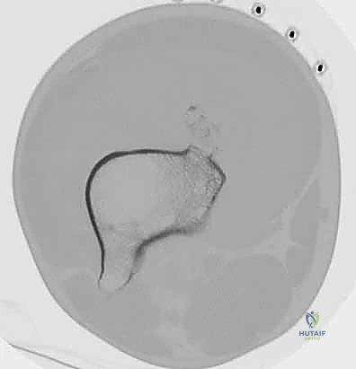 تجميع الطرف الاصطناعي