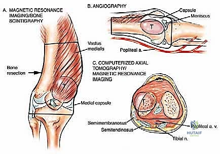 قطع العظم السليم