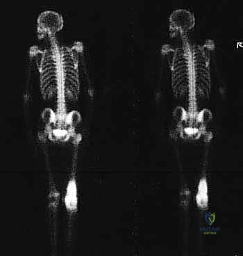 إدخال الجذع المعدني