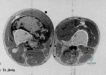 استخدام الأسمنت العظمي