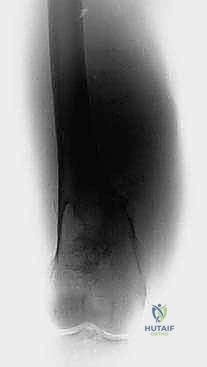 تحضير القناة النخاعية