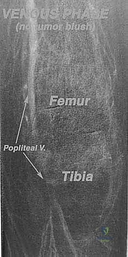 توصيل المفصل المفصلي