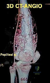 التأكد من استقرار الركبة