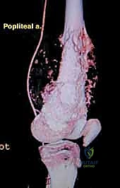 الشكل النهائي للطرف المعدني