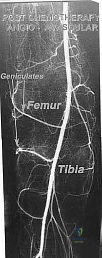 تثبيت مكون قصبة الساق