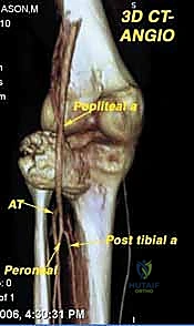 إعادة بناء العضلات