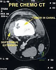 صورة توضيحية لـ إعادة بناء عظم الفخذ البعيد بالطرف الاصطناعي
