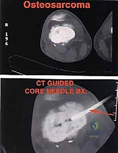 عزل الأوعية الدموية
