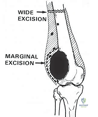 صورة طبية: إعادة بناء عظم الفخذ البعيد بالطرف الاصطناعي: أمل جديد لمرضى أورام العظام في صنعاء مع الأستاذ الدكتور محمد هطيف
