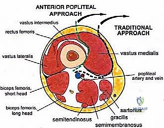 صورة طبية: إعادة بناء عظم الفخذ البعيد بالطرف الاصطناعي: أمل جديد لمرضى أورام العظام في صنعاء مع الأستاذ الدكتور محمد هطيف